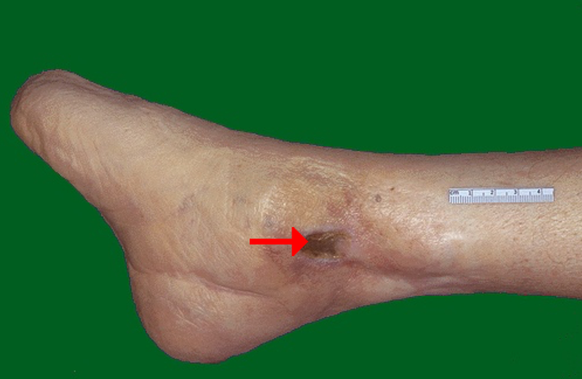 <ol><li><p>Possible underlying causes of the ulceration</p></li></ol><p></p>