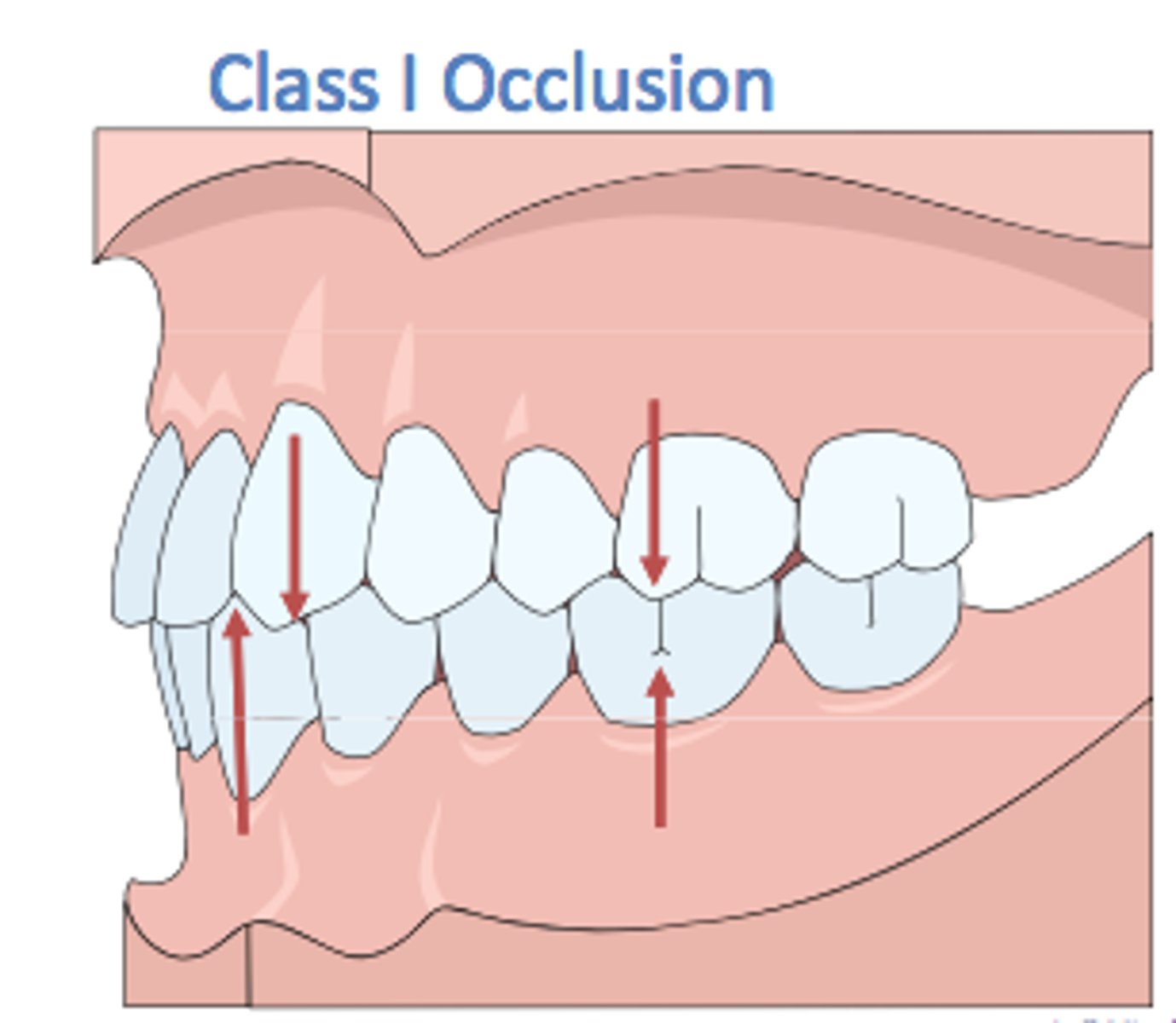 <p>(Mesognathic) Normal</p><p>-Mesiobuccal cusp of the maxillary first molar is positioned in the buccal groove of the mandibular first molar.</p><p>-Maxillary canine occluded with the distal half of the mandibular canine and the mesial half of the mandibular first premolar</p><p>-Malposition of individual teeth or groups of teeth</p>