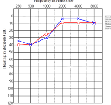 <p>What patient is this? what kind of hearing loss is this?</p>