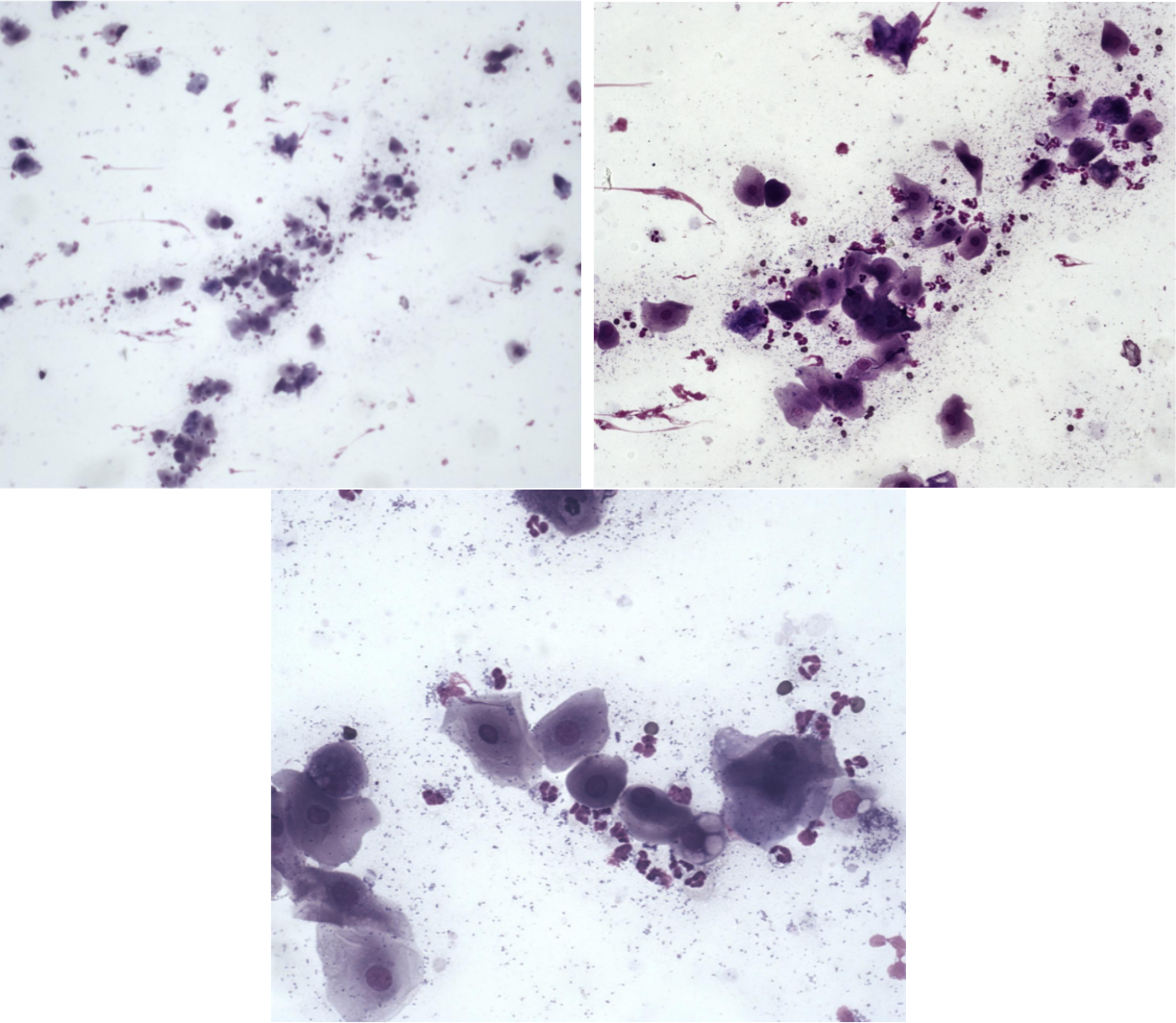 <p>Utstryk 5<br>Parabasalceller: <br>Intermediärceller: <br>Superficialceller: <br>Erytrocyter: <br>Neutrofiler:</p><p>Stadium:</p>