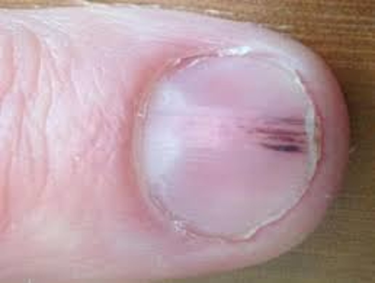 <p>Thin reddish-brown lines of blood under the nails</p><p>Causes:</p><p>-Endocarditis (infection of the heart valve)</p>