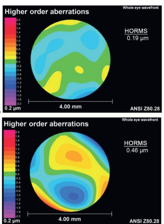 <p>wavefront aberrometers</p><ul><li><p>those with corneal ectasias experience MORE higher order aberrations</p></li></ul>