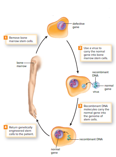 Ex vivo gene therapy in humans.