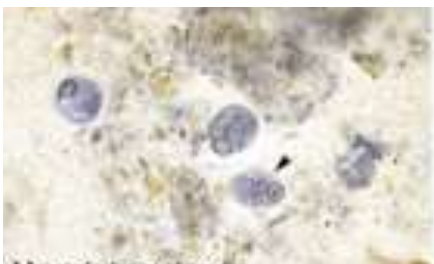 ADDITIONAL INFORMATION: Chilomastix Mesnili:

identify the stain used: 

* Grayish-charcoaled color in brown background