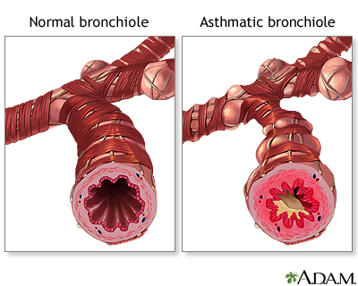 Hyperreactivity of the bronchi and bronchioles with bronchospasm, inflammation, and excess mucus production