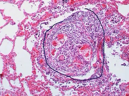 <p>-young women</p><p>-PVR</p><p>-endothelin; NO</p><p>-plexiform lesions; endothelial proliferation; multiple lumens</p><p>-BMPR2; inhibits smooth muscle proliferation; familial</p>