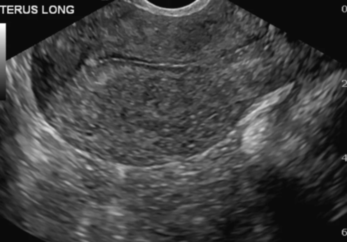 <p>Late proliferative</p>