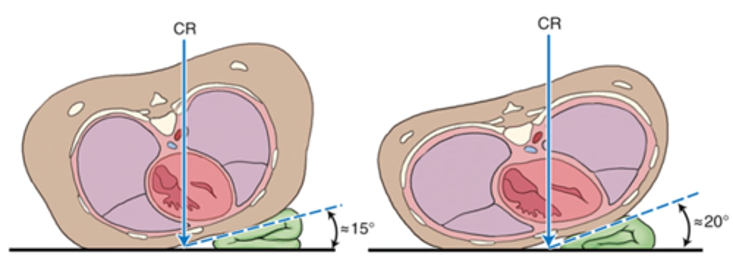 <p>A) 20°</p><p>pg. 359: a patient with a shallow or thin chest requires more rotation than a patient with a deep chest to cast the sternum away from the thoracic spine.</p><p>Hypersthenic patient has a greater AP measurement and requires less rotation (15°)</p><p>Asthenic patient has a decreased AP and requires more rotation (20°).</p>