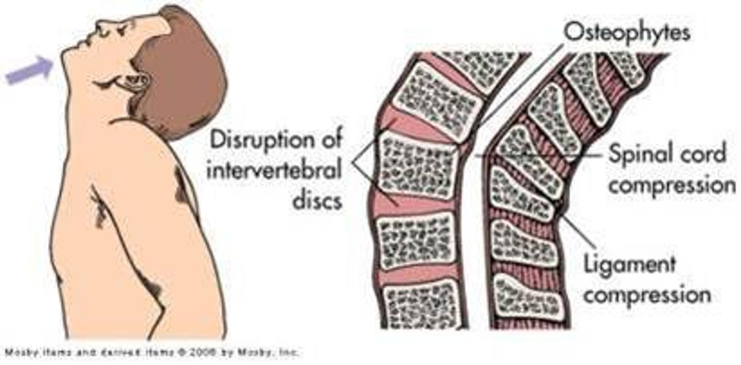 <p>Define Spinal Cord Trauma</p>