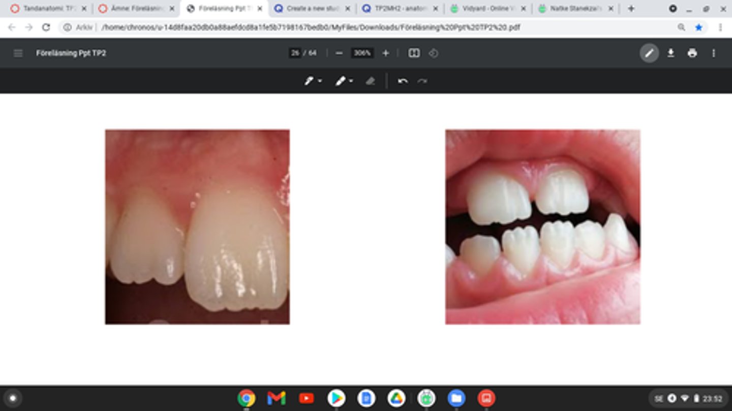 <p>Kan finnas på incisivernas labiala yta där de framträder som vertikala små upphöjningar. På incisala kanten kan de urskiljas som små knoppformade taggar. <br><br>Upphöjningarna syns tydligast på ny-erupterade incisiver. Mamelonerna slips dock fort ner, främst på incisivkanten.</p>