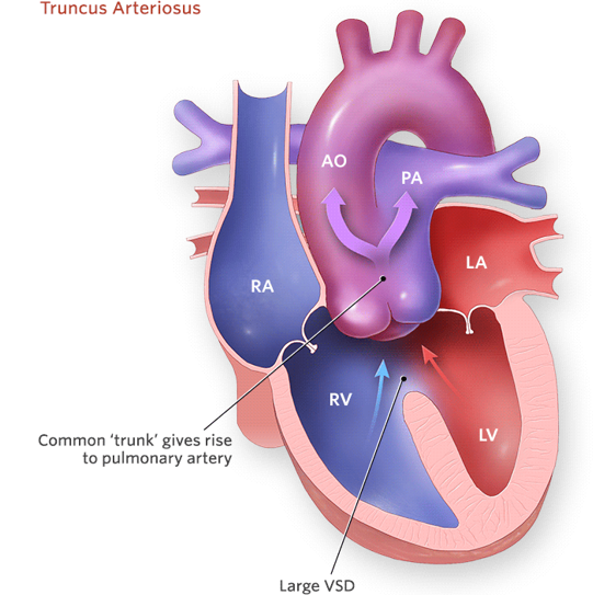 <p><strong><u>Mixed</u> Defect</strong></p><ul><li><p class="">Single large vessel.</p></li><li><p class="">Decreased systemic blood flow.</p></li><li><p class="">Requires surgical intervention.</p><ul><li><p class="">Not compatible with life for long (weeks or months).</p></li></ul></li></ul><p></p>