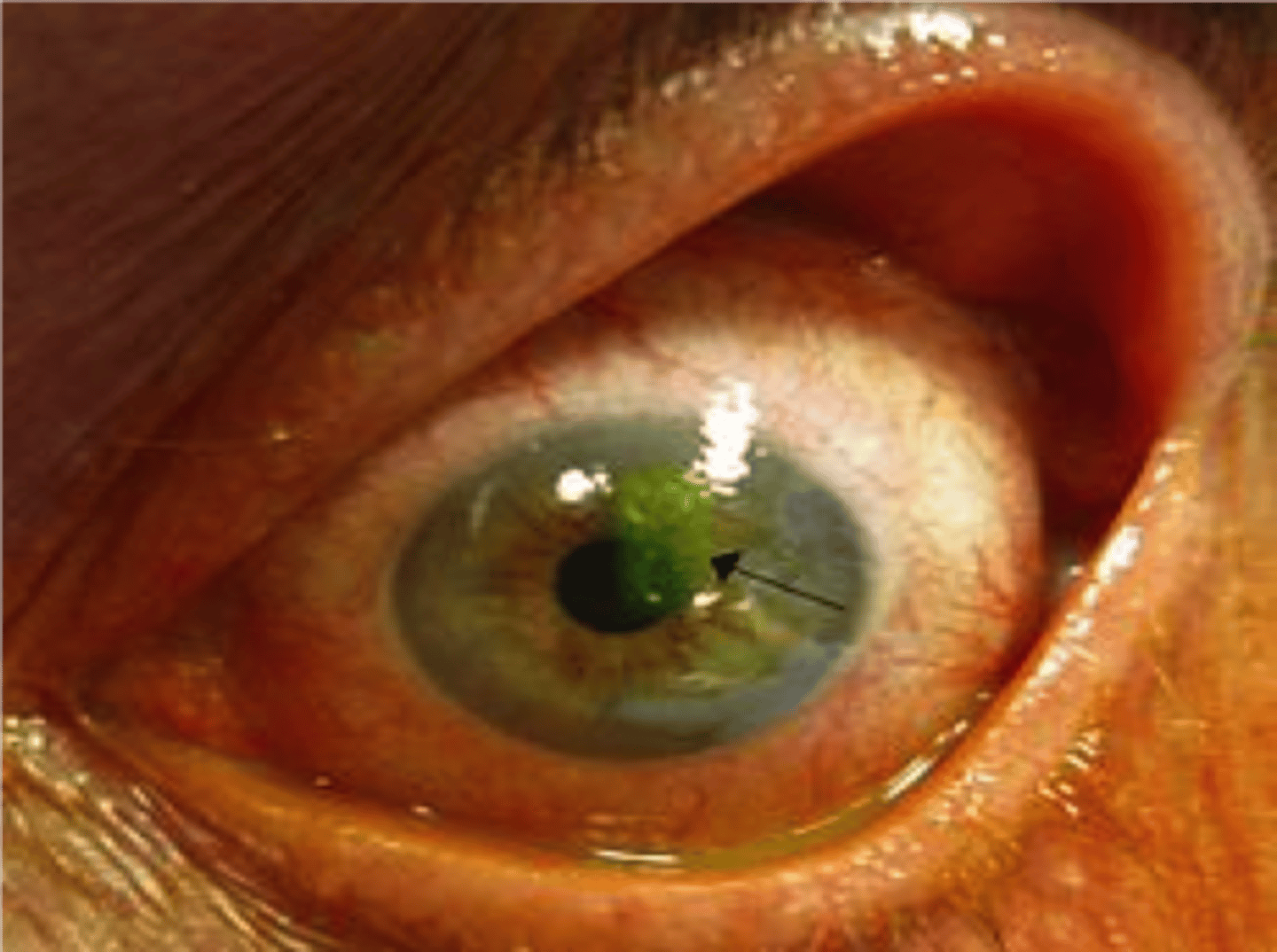 <p>Corneal abrasion</p>