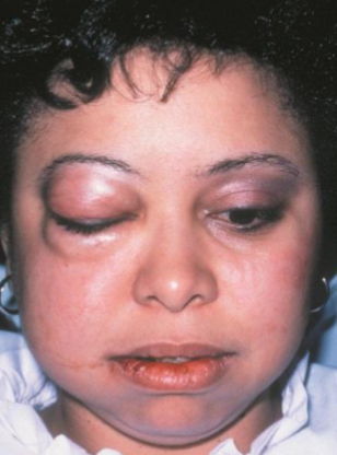 <p>rapid onset of facial swelling and pain </p>