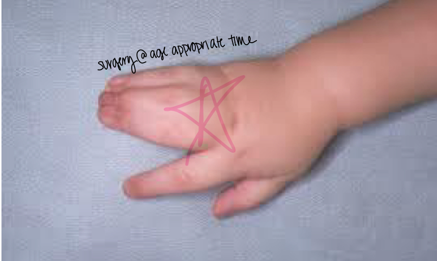<p>2 or more digits that are fused together </p><p>Can be fingers or toes</p>