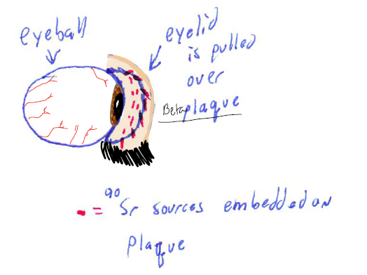 <p><strong>Strontium 90 Beta Plaque</strong> under the eyelid</p>
