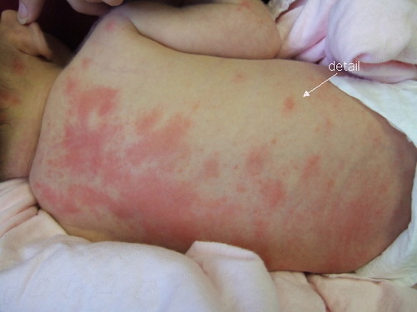 <p>blotchy red macules seen on the chest, back, and face in full term babies</p>