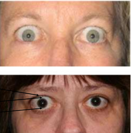 <ol><li><p>upper eyelid is too high and lower eyelid is too low </p></li><li><p><strong><u>Dalyramples sign - retraction of the upper lid on primary gaze </u></strong></p></li></ol><p></p>