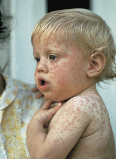 <p>caused by Measles virus</p><p>Transmitted by respiratory route (droplets)</p><p>Starts on head → spreads to body; Macular rash and Koplik’s spots in mouth; high fever.</p><p>Prevented by MMR vaccination and supportive care</p><p></p>