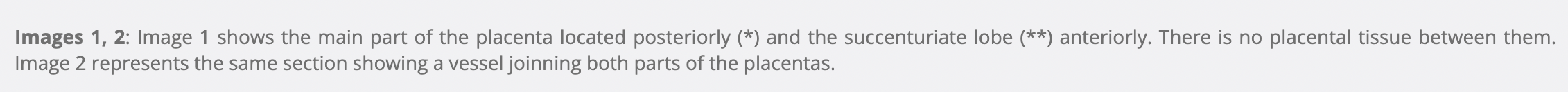 <p>c) succenturiate placenta</p>