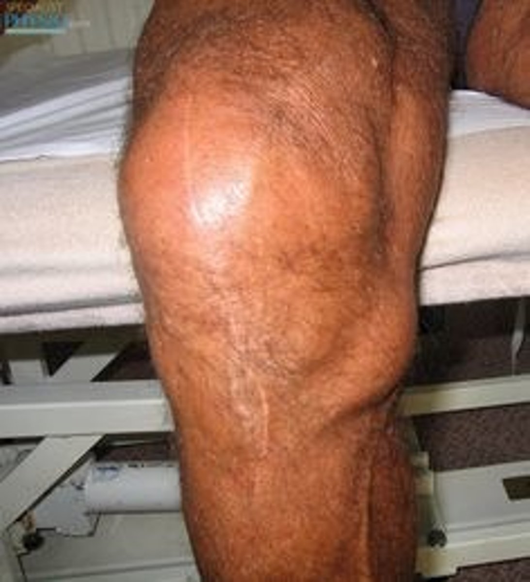<p>MEDIAL knee pain; secondary to overuse</p>