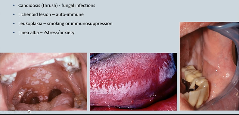 <ol><li><p><strong>Candidosis (thrush</strong>) </p></li><li><p><strong>Lichenoid lesion</strong></p></li><li><p><strong>Leukoplakia </strong> </p></li><li><p><strong>Linea alba </strong></p></li></ol><p></p>