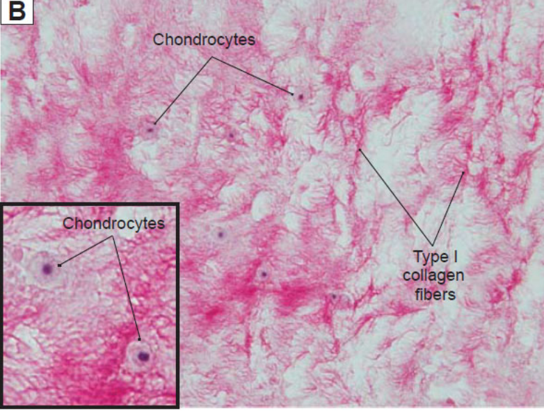 <ul><li><p>riche en faisceaux de fibres de <strong>collagène</strong> de type I, sont orientées selon</p><p>la direction des contraintes → grd résistance aux tractions/compressions</p></li><li><p><strong>chondrocytes</strong> sont plus petits et moins nombreux</p></li><li><p>moins souple et peut se déchirer</p></li><li><p>se trouve au niveau des disques intervertébraux, de la symphyse pubienne et de quelques articulations (ménisques du genou), au niveau de l'insertion des tendons</p></li></ul><p></p>