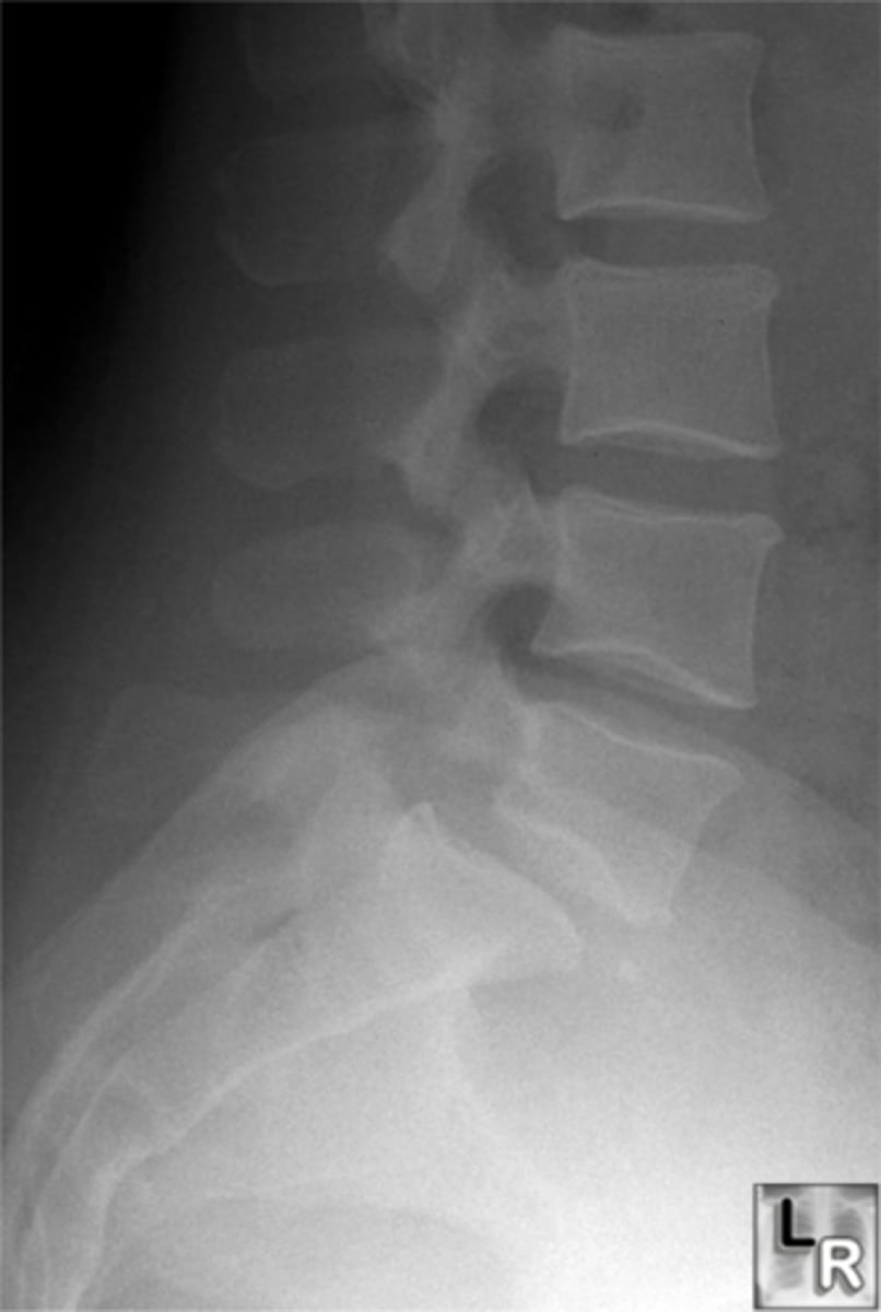 <p>Vignette # 26</p><p>Sex: Female</p><p>Age: 71</p><p>Chief Complaint: Patient presents with sudden onset of low back pain 18 hours ago. Ice makes it feel better. The pain is rated and 8 out of 10 on the pain scale</p><p>Objective Findings: No orthos due to pain</p><p>Diagnostic Imaging: X-ray</p><p>2. What are the best treatment options for this condition? (Choose 3)</p><p>a. Extension exercises</p><p>b. Orthopedist</p><p>c. Modified ADLs</p><p>d. Strengthen hip flexors</p><p>e. Adjust</p><p>f. Cryotherapy</p><p>g. Oncologist</p><p>h. Bed rest</p>