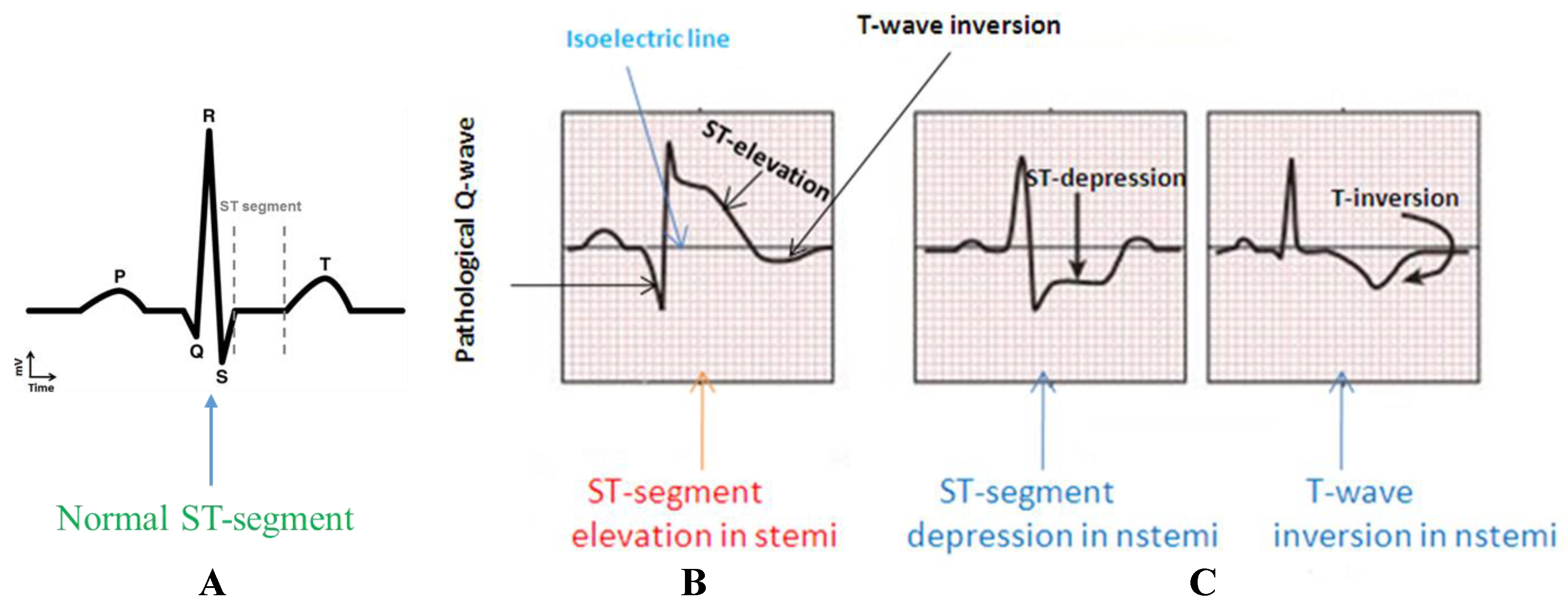 <p><strong>NSTEMI does not typically show ST-elevation</strong> but may display non-specific changes like<strong> ST-depressions, T-wave inversions, or a loss of R-wave amplitude</strong>, reflecting less severe but significant myocardial injury.</p>