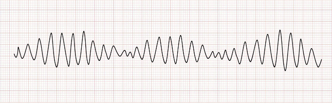 <ul><li><p class=""><strong>Rate:</strong> <em>Ventricular</em> — <mark data-color="yellow" style="background-color: yellow; color: inherit">100 to 200 bpm</mark></p></li><li><p class=""><strong>Rhythm:</strong> Looks like twisting points or peaks on the ECG</p></li><li><p class=""><strong>P Waves:</strong> N/A</p></li><li><p class=""><strong>P to QRS Ratio:</strong> N/A</p></li><li><p class=""><strong>PR Interval:</strong> N/A</p></li><li><p class=""><strong>QRS Complex:</strong> Bizarre, with fluctuations in amplitude</p></li></ul><p><em>“Twisting of Pointes</em>”</p>