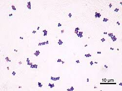 <p><span data-name="test_tube" data-type="emoji">š§Ŗ</span> <strong>Lab differentiation:</strong> Gram stain shows purple grape-like cocci clusters. On blood agar, colonies are golden-yellow and beta-hemolytic. On Mannitol Salt Agar, ferments mannitol turning media yellow. Catalase- and coagulase-positive.</p><p><span data-name="woman_health_worker" data-type="emoji">š©āā</span> <strong>Patient scenario:</strong> A college wrestler develops a pus-filled boil on his thigh. Swab culture grows golden-yellow colonies, Gram stain shows clusters, and coagulase test is positive.</p><p>(A) Classification: Gram-positive bacterium; cocci in clusters.<br>(B) Disease: Abscesses, pneumonia, food poisoning, toxic shock syndrome.<br>(C) Identification/Diagnosis: Gram stain, mannitol fermentation, coagulase test.<br>(D) Treatment/Prevention: Nafcillin (MSSA) or vancomycin/linezolid (MRSA). Abscess drainage. Hygiene prevents spread.<br>(E) Unique Epidemiology & Lab Safety: Found in nose/skin of ~30% of people. Virulence: Protein A, toxins. BSL-2 organism.</p>