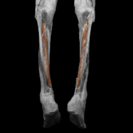 <p>origin: tibia, fibula, interosseous membrane </p><p></p><p>insertion: metatarsal II-IV, navicular, cuneiform</p><p></p><p>action: plantar flex, supinate foot </p><p></p><p>innervation: tibial nerve </p>