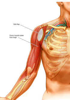 <p>Brachial</p>