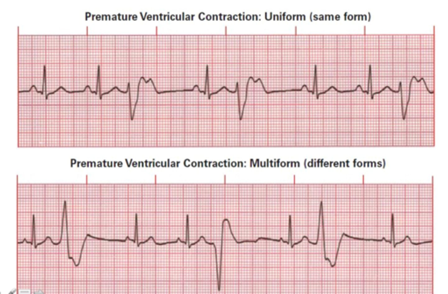 <p>Unifocal: PVC originating from one site, all abnormal QRS complexes will looks the same</p><p>Multifocal: PVC originating from multiple sites, abnormal QRS complexes will look different</p>