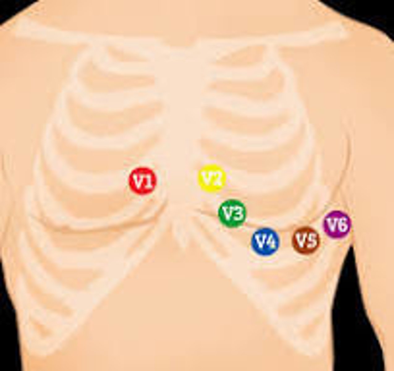 <p>on the left anterior azillary line, horizontal to V4</p>