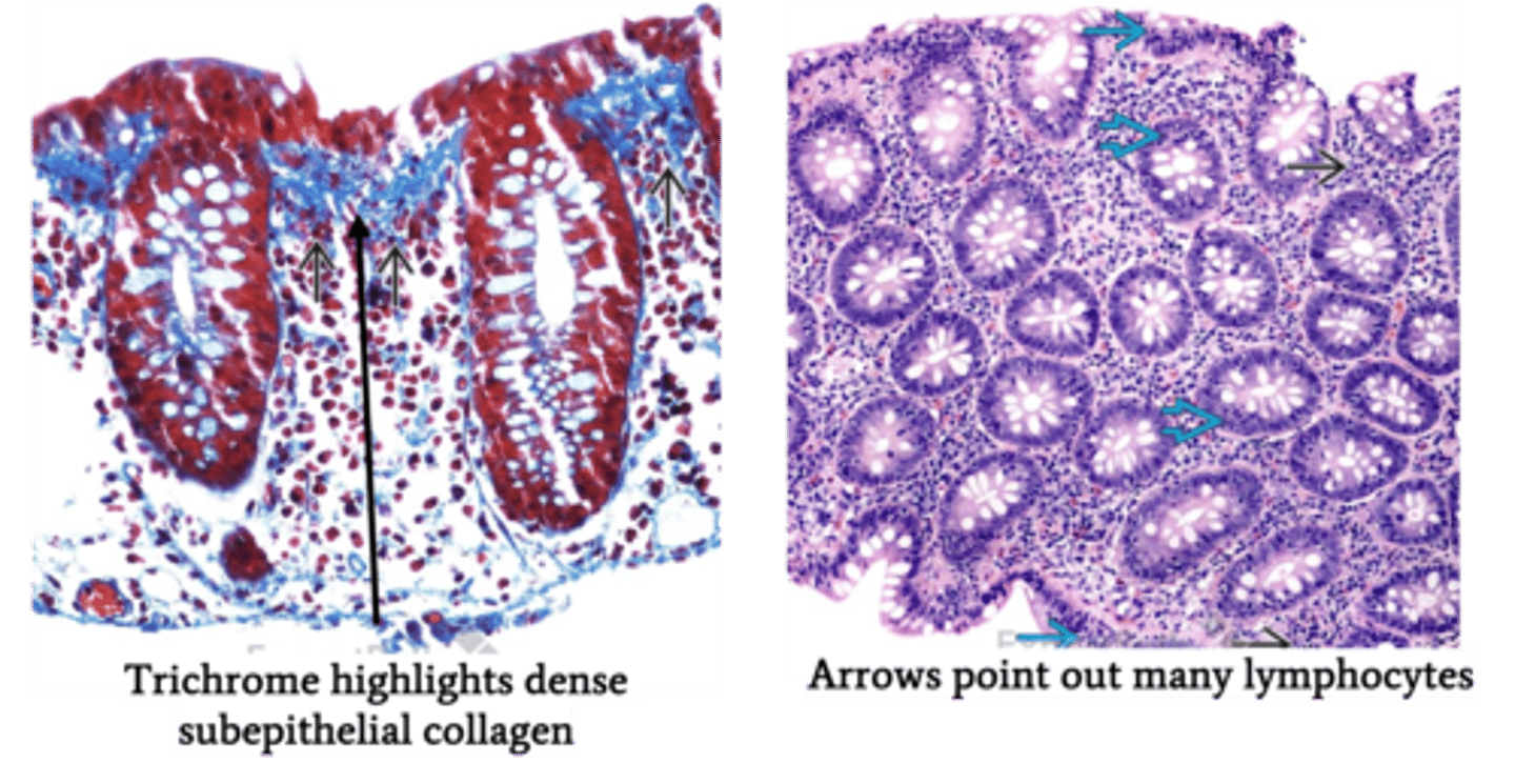 <p>Define Condition:</p><p>Inflammatory disease of colon</p><p>-Hx: IDIOPATHIC</p><p>&gt; Collagenous = Middle aged/Older Women</p><p>&gt; Lymphocytic = A/w...</p><p>&gt;&gt; Celiac disease</p><p>&gt;&gt; Thyroiditis</p><p>&gt;&gt; Arthritis</p><p>&gt;&gt; Autoimmune Gastritis</p><p>-Sx/PE:</p><p>&gt; Chronic Non-Blood Watery Diarrhea</p><p>&gt; No Wt Loss</p><p>-Dx:</p><p>&gt; Endoscopy = Normal Colonic Mucosa</p>