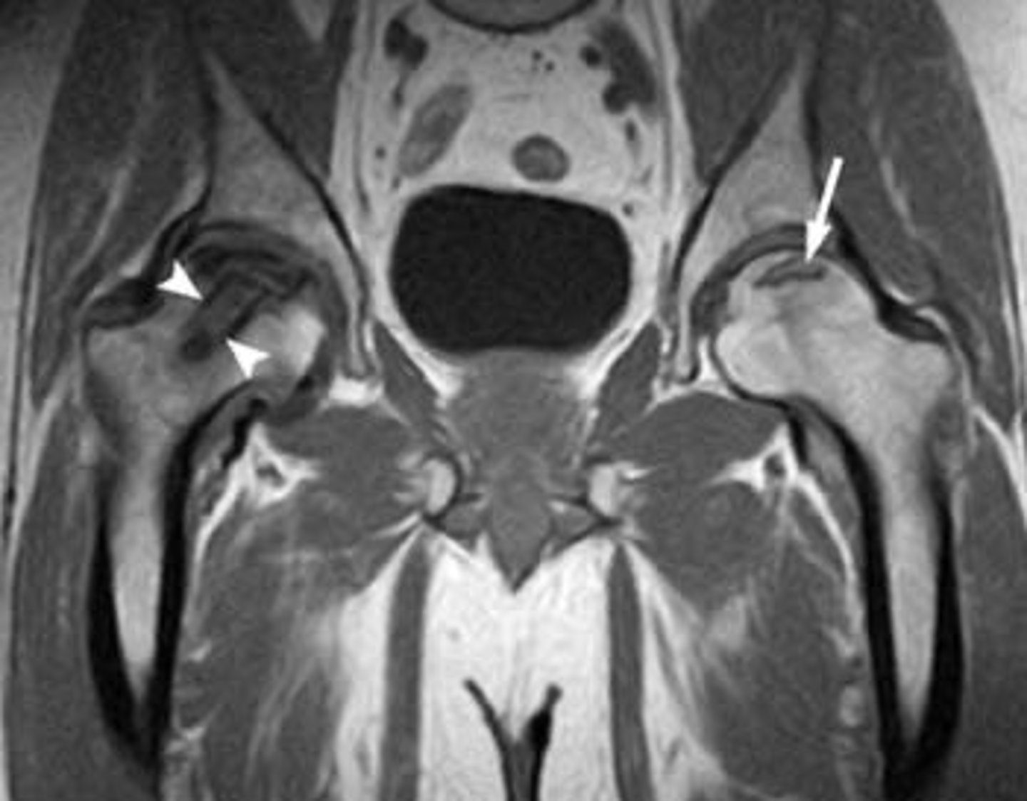 <p>X-ray</p><p>•Sclerosis or cystic changes</p><p>•Flattening, subchondral radiolucent lines</p><p>•Subchondral collapse of the femoral head</p><p>MRI-GOLD STANDARD if x-ray is inconclusive and have a high suspicion. Highest sensitivity (99%) and specificity (99%)</p><p>•Bone marrow edema and chondral changes</p>