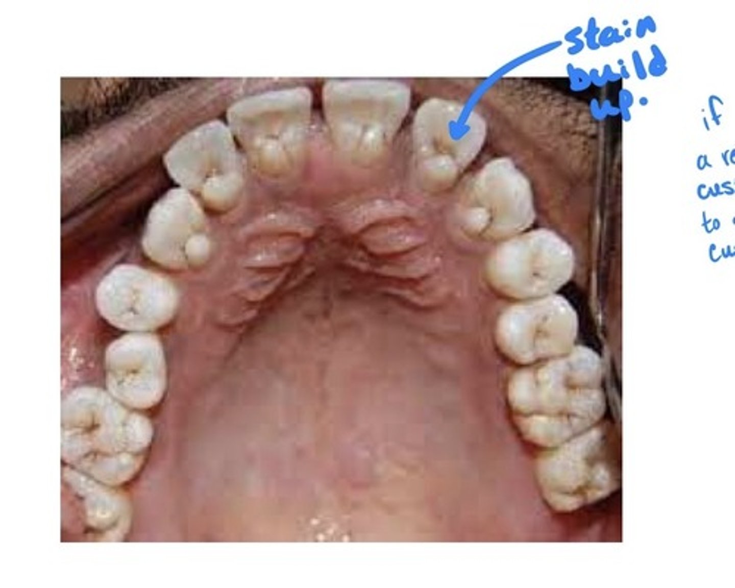 <p>An accessory cusp located in the cingulum area of a max or mand permanent incisor. Contains a pulp horn. May interfere with occlusion.</p>