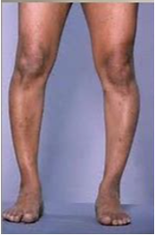 <ul><li><p>Loss of vitamin D – may be rare in US</p><ul><li><p>Loss of calcium</p></li><li><p>Bone softening/weakening</p></li></ul></li><li><p>Same as rickets in children</p></li></ul><p></p>