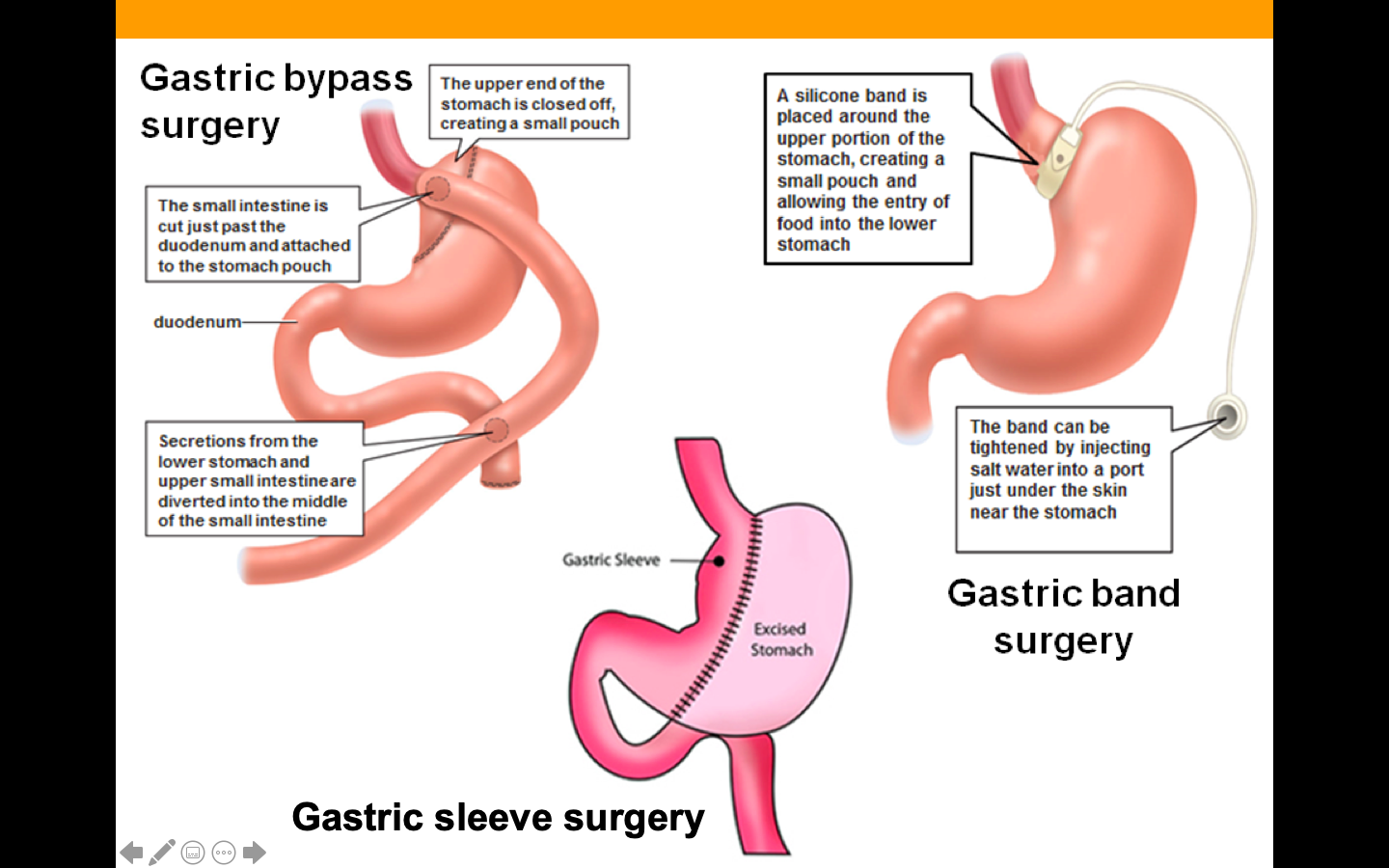 Gastric bypass – surgery to close off part of stomach/intestine
Benefits~ weight loss decreases a person's risk of coronary heart disease, stroke and peripheral heart disease.
Changes~ Diet & exercise
 False
The stomach will expand lager until it goes back to its original size. Must change lifestyle/diet