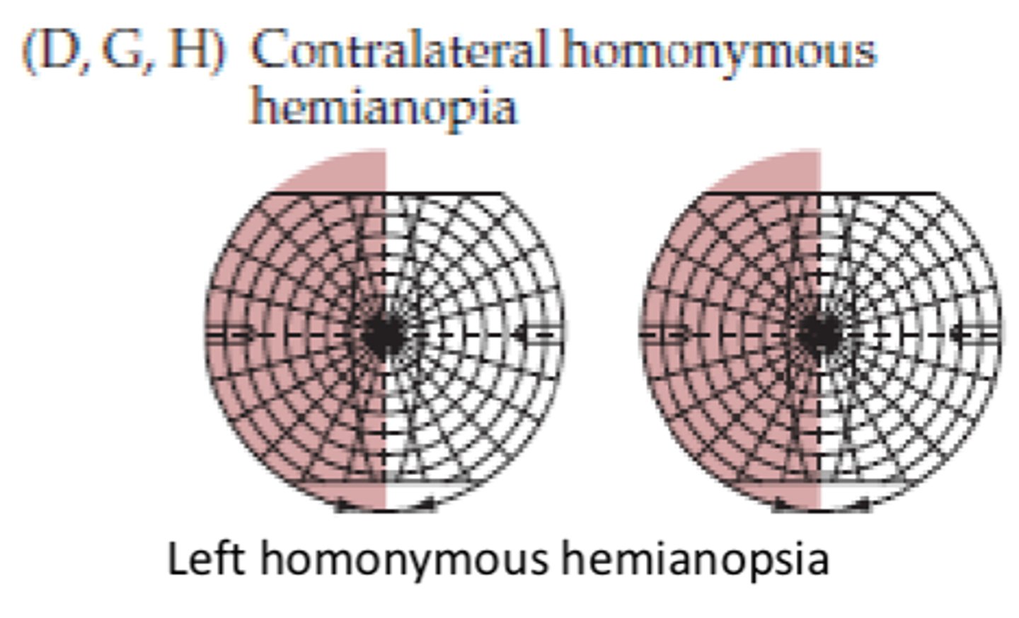 <p>Contralateral homonymous hemianopia</p>
