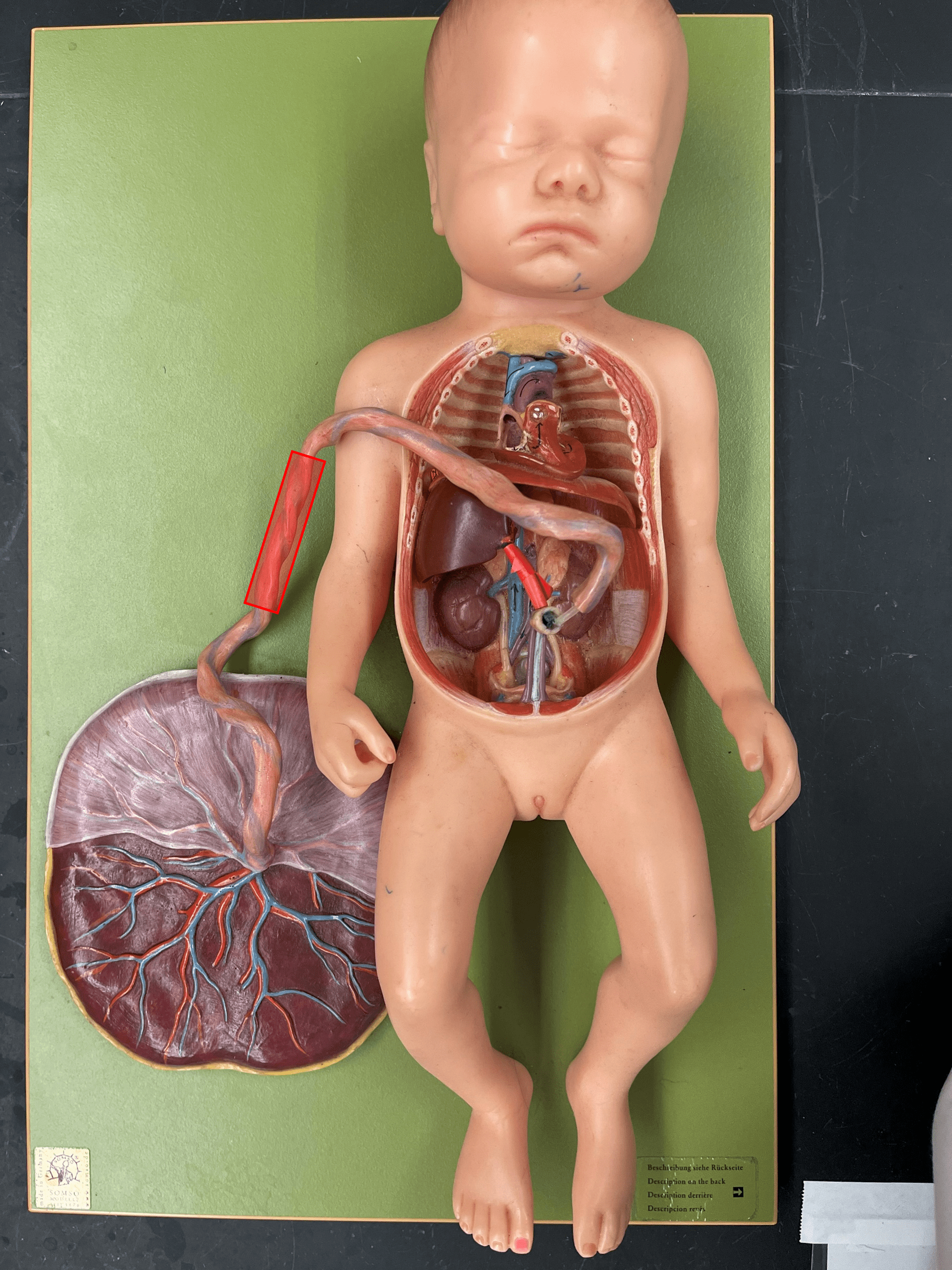 • Connects the fetus to the placenta.

• Contains an umbilical v. and two umbilical aa. as part of the fetal circulation.