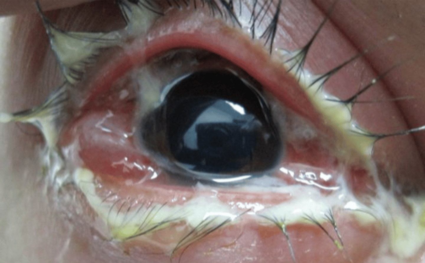 <p>*hyperacute mucopurulent conjunctivitis (often w a concurrent urethritis)</p>
