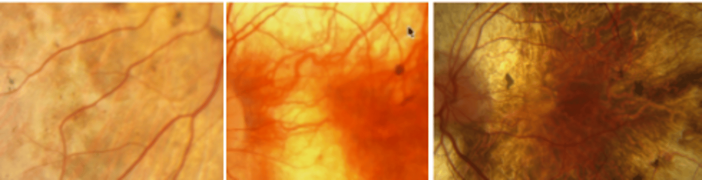 <p>an X linked progressive diffuse degeneration of the choroid, RPE, and retinal photoreceptors. Presents in the 2nd-3rd decade with nyctalopia and constricted visual fields. Central vision is spared up until the 6th decade, prognosis is poor. ERG and EOG subnormal. VF shows annular scotomas that eventually involve fixation.</p>