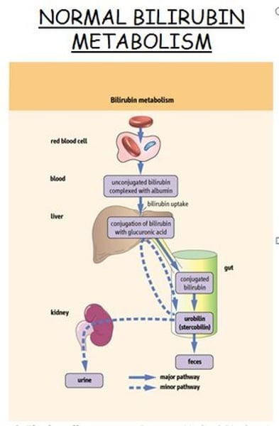 <p>a orange-yellow pigment formed in the liver by the breakdown of hemoglobin and excreted in bile (feces eventually) and urine<br>- high serum bilirubin: indicates improper liver function</p>