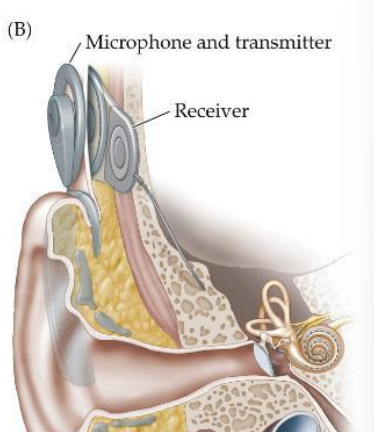 <p>tiny flexible coils with mini electrode contacts, surgeons thread implant through round window toward cochlear apex , tiny mic transmits radio signals to receiver int the scalp, computer chip performs Fourier transform and stimulates appropriate location in cochlea for each frequency </p>
