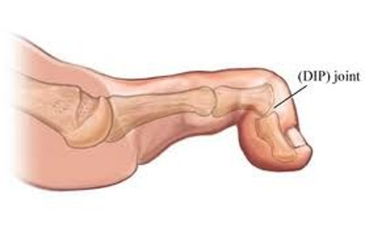 <p>mallet toe</p>