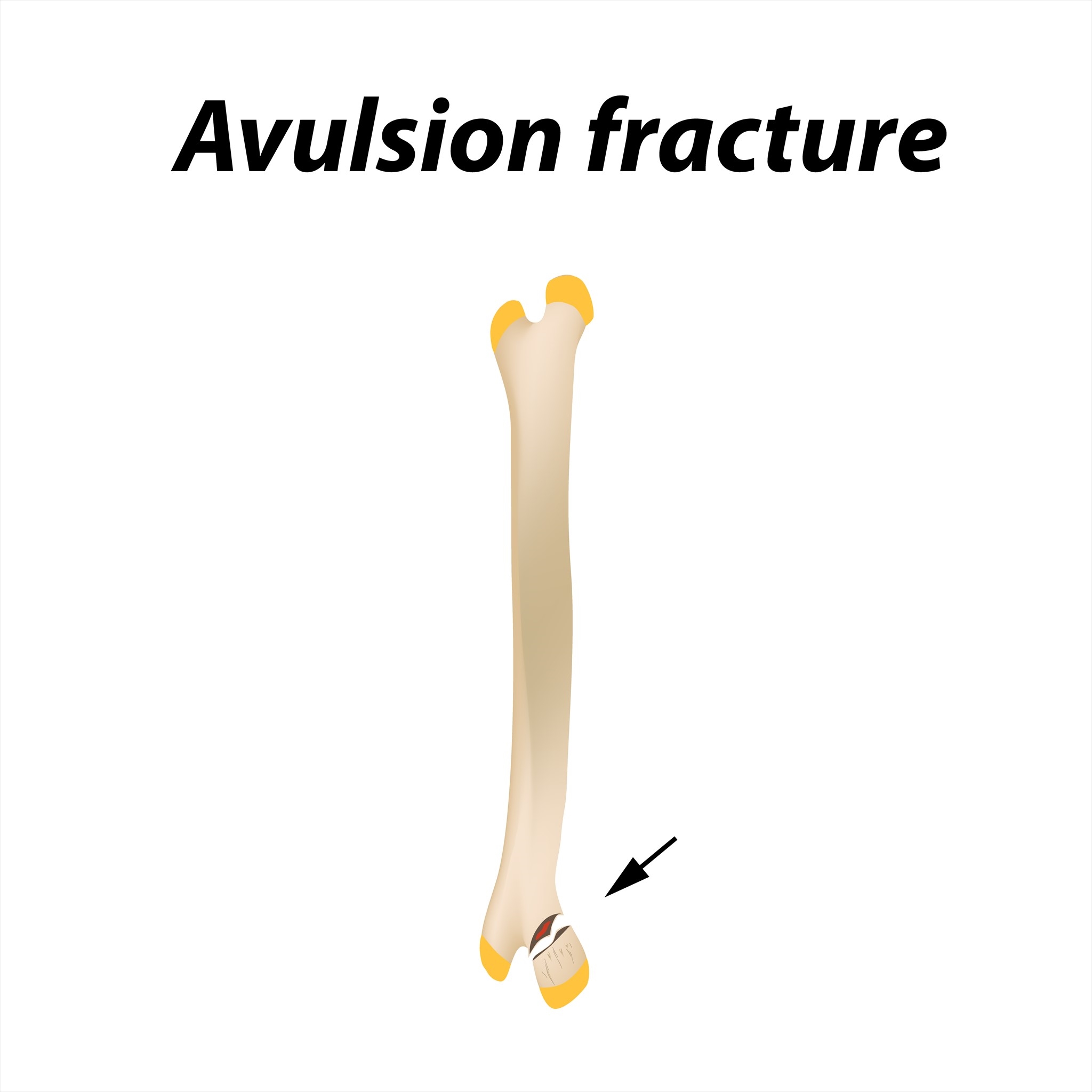 <p>avulsion fracture</p>