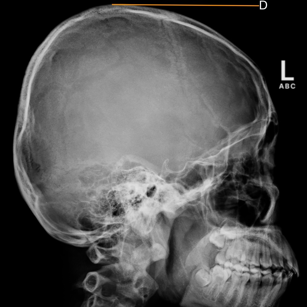 <p>Identify the structure that is represented by the letter (D):</p><ol><li><p>Occipital bone</p></li><li><p>Lambdoidal suture</p></li><li><p>Sella turcica</p></li><li><p>Vertex</p></li></ol><p></p>