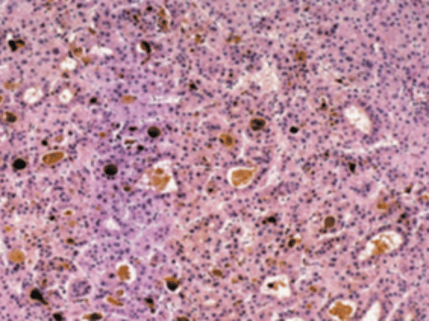 <p>A 68-year-old man complains of vague abdominal pain, intermittent fever, and a 20-lb (9-kg) weight loss over the past 6 months. For the past 12 years, he has suffered from chronic hepatitis B. On physical examination, the patient shows diffuse abdominal tenderness, hepatomegaly, and mild jaundice. A CT scan of the abdomen reveals a diffusely nodular liver, with a dominant mass measuring 3 cm in diameter. A needle biopsy is shown in the image. Which of the following serum markers is useful for monitoring the progression of disease in this patient?</p><p>(A) Alkaline phosphatase</p><p>(B) Alpha-fetoprotein</p><p>(C) Anti-HBc antibody</p><p>(D) Carcinoembryonic antigen</p><p>(E) Human chorionic gonadotropin</p>