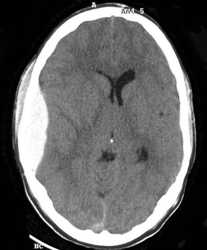 <p>Extradural haematoma pathology</p>